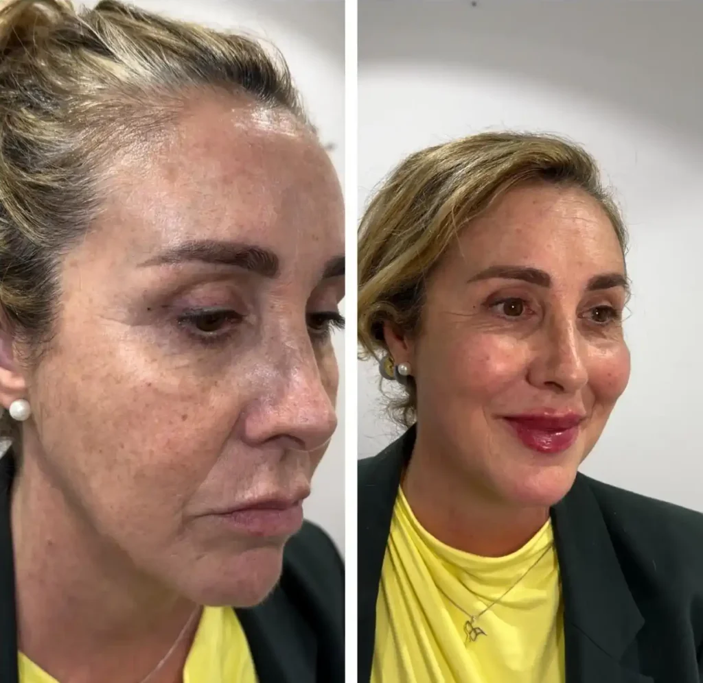 Antes y después del tratamiento Full Face para rejuvenecimiento